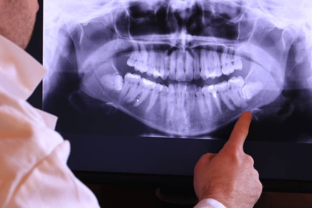 Best Emergency Tooth Extraction in Menard, TX