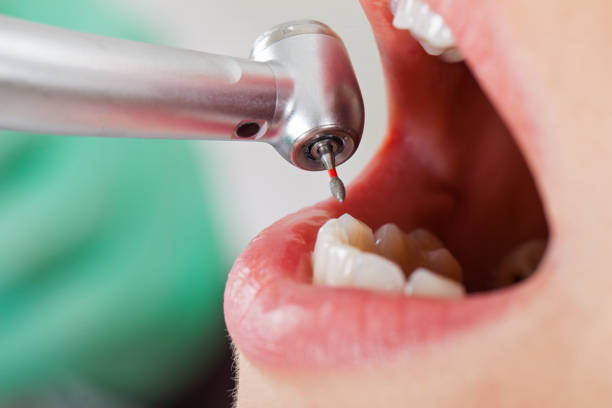 Best Emergency Wisdom Teeth Removal in Menard, TX